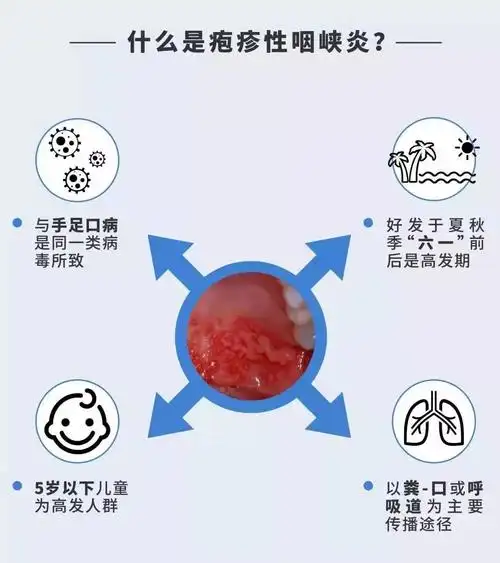 疱疹性咽峡炎(herpangina)是由肠道病毒引起的以急性发热和咽峡部疱疹