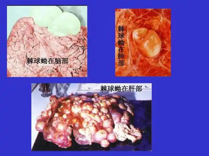 棘球蚴在脑部 棘 球 蚴 在 肺 部 棘球蚴在肝部