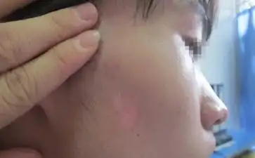 白斑病的症状有哪些