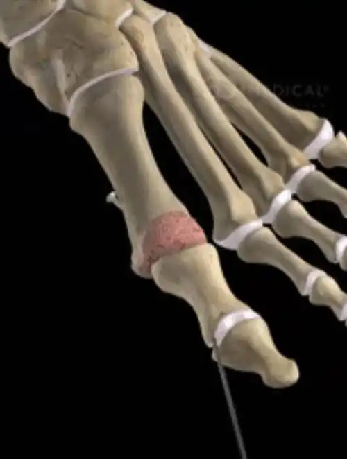 我的大脚趾不能动了,我该怎么办? (原创)