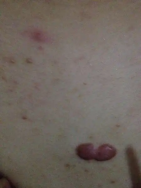 皮肤上长肉瘤,是什么,安着又痒又痛,不安,没事,从小的长成大的,大的