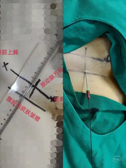 股动脉穿刺是神经介入医生的入门级技术,对于老司机来说是轻而易举的