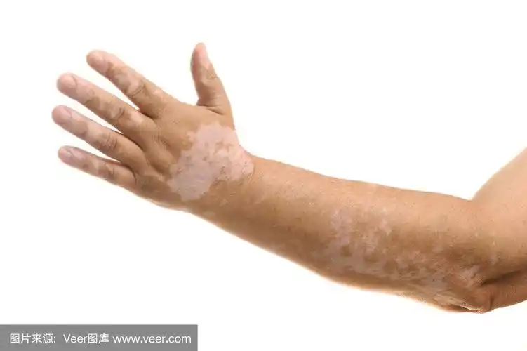 手臂和手上有白癜风
