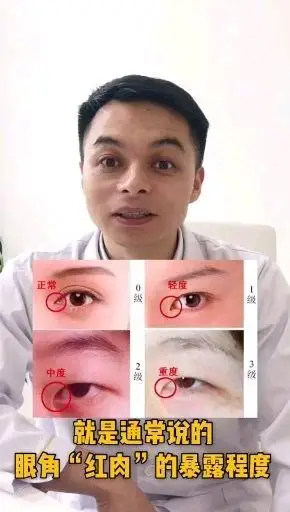你需要开内眼角吗?内眼角分3度,以眼角"红肉"暴露_圈子-新氧美容整形