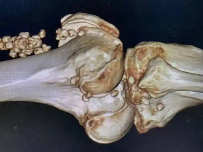 在当地医院做了x线检查, 当地医生发现 王师傅的膝关节里密密麻麻的