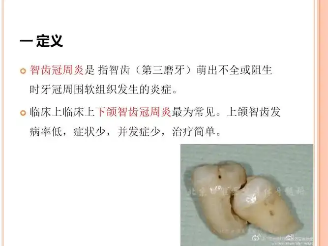 智齿冠周炎培训讲学