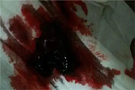 不同经血颜色辨别身体健康