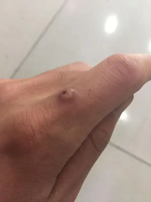 请教下大家,我手指上长了个疙瘩,开始很小,我戳破了,后来就长大了