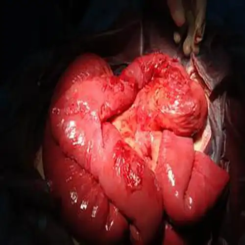 胃息肉的癌症图片