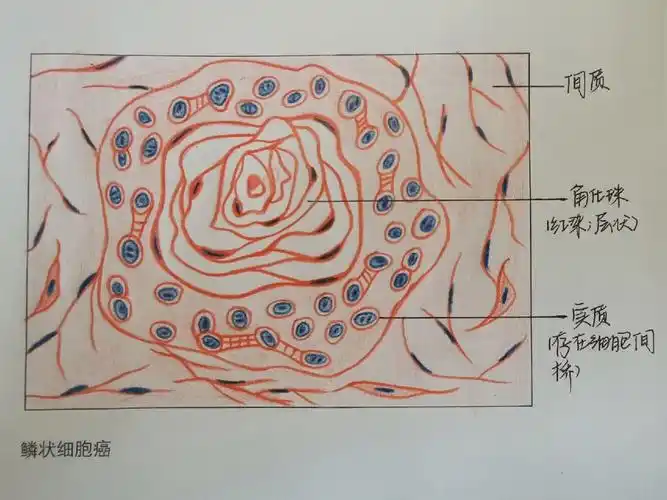 病理实验报告鳞状细胞癌绘图