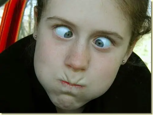 斗鸡眼图片 (48)_有来医生