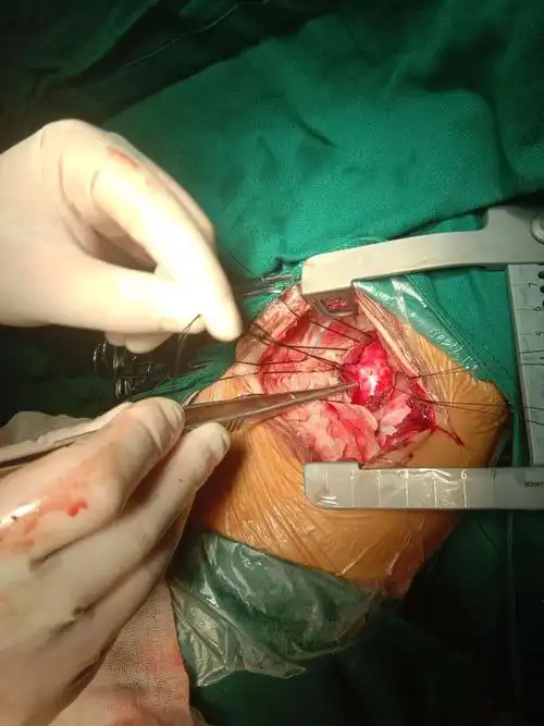 凉山州中西医结合医院圆满完成首例先天性心脏病矫治手术