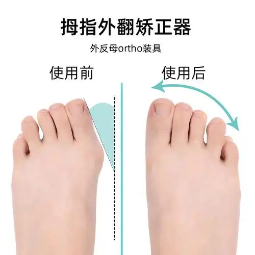脚大拇指外翻矫正女儿童脚趾矫正器大脚骨姆趾分趾器男硅胶可穿鞋