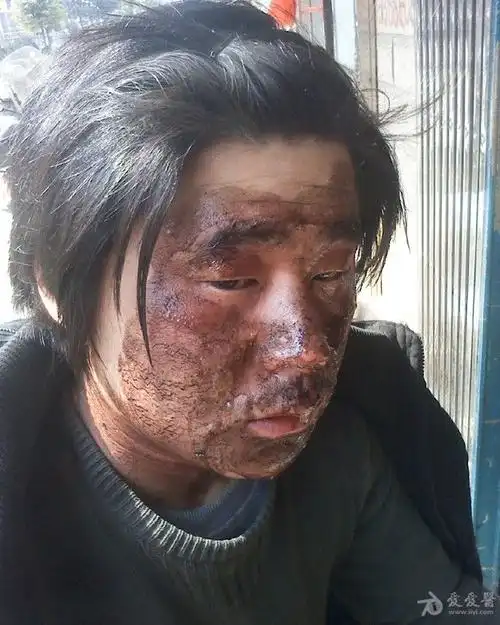 同样度数的烧伤,面部烧伤最易愈合