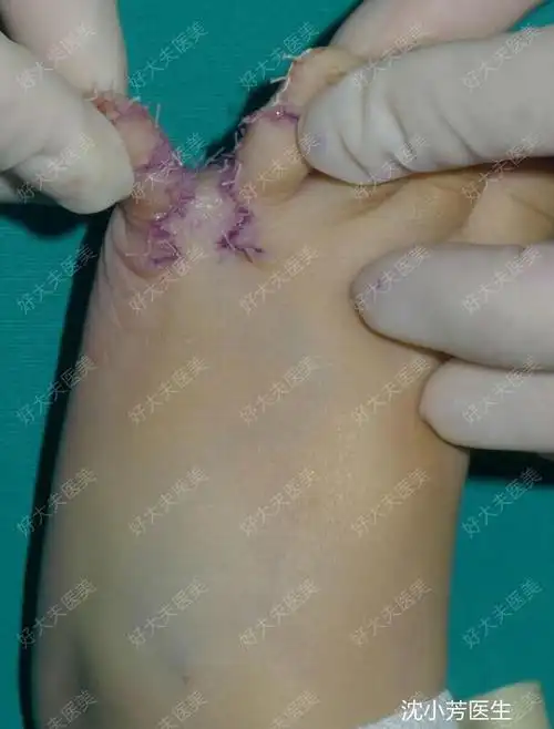 治疗后0天治疗后这位小宝宝术前是左脚并指畸形,经过手术后,术后即刻