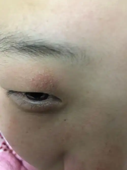 眼睛的眼皮上面好像长了什么东西,有人知道吗,已经几天了?