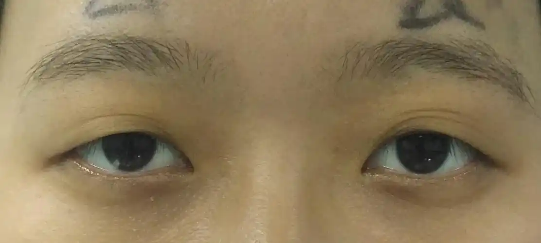 各种上睑下垂术前术后对比照 - 好大夫在线