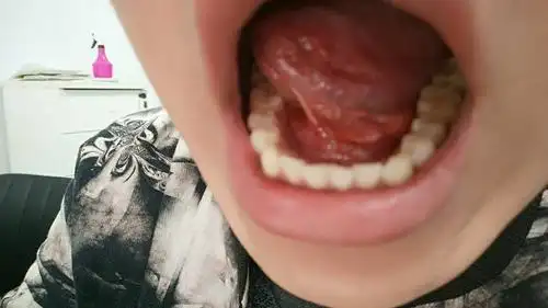 求大神看一下舌头下面鼓起一个肉包