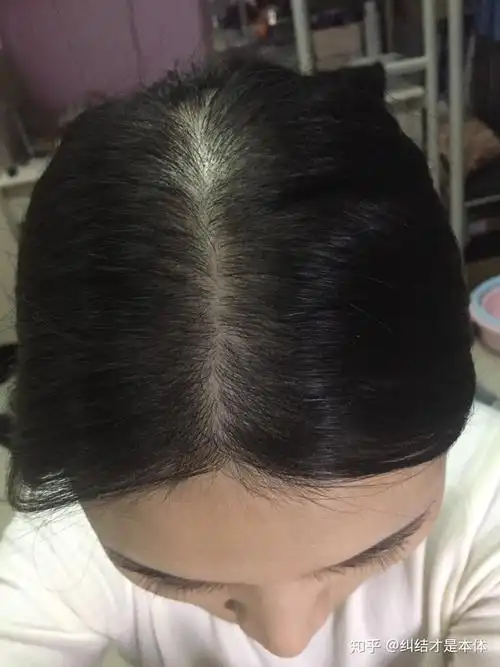 女生 发量少 头顶快秃了 有没有什么好的生发方法!跪求! - 知乎