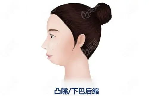 正雅s8颌位重建隐形矫正不做正颌手术也解决了她下巴后缩嘴凸的问题