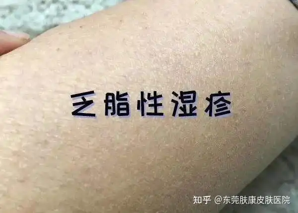 秋冬时节皮肤干燥开裂可能是干性湿疹作祟