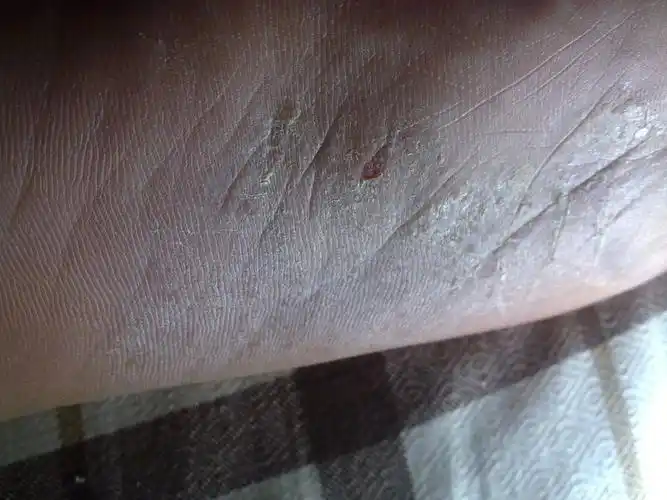 我男朋友自从到了北京以后脚板心开始长东西很干,抽筋一样的,有些痒.