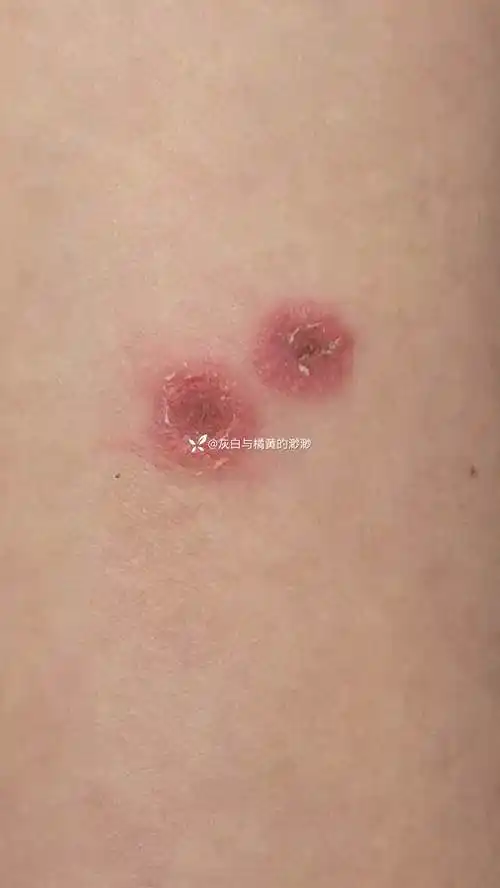 猫癣,二期梅毒疹