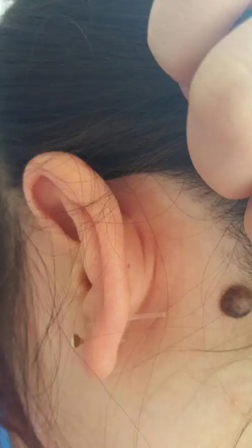 耳朵后靠头发的位置有这么大个痦子!