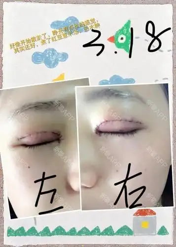 双眼皮 开眼角