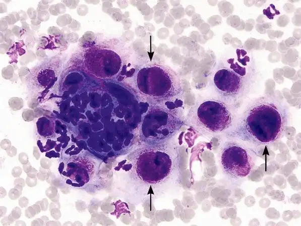 8张高清典型细胞学图片快速了解血清肿,钙质沉着,超敏反应,落叶天疱疮