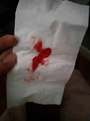 肛门出血,该怎麼办?