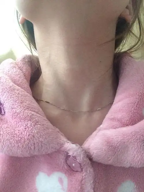 请问,颈椎受伤一定会有颈椎疼痛吗?