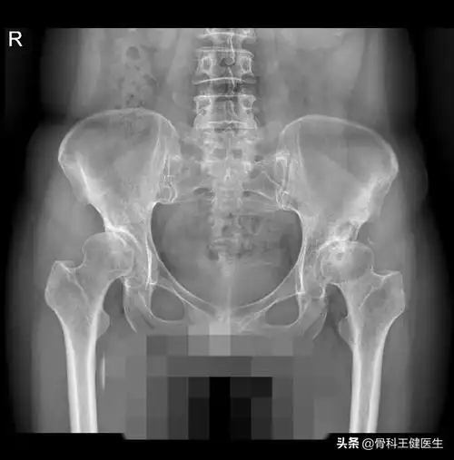 髋关节发育不良继发骨关节炎一例