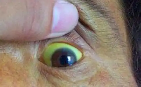 男性肝硬化早期症状有哪些