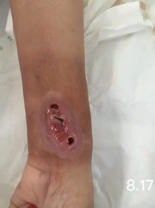 留置针针眼感染