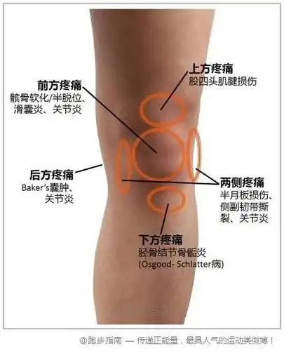 【膝关节疼痛原因】一张图教会你初步判断