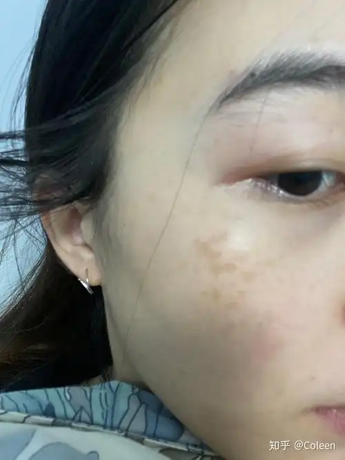 褐青色痣超皮秒日记