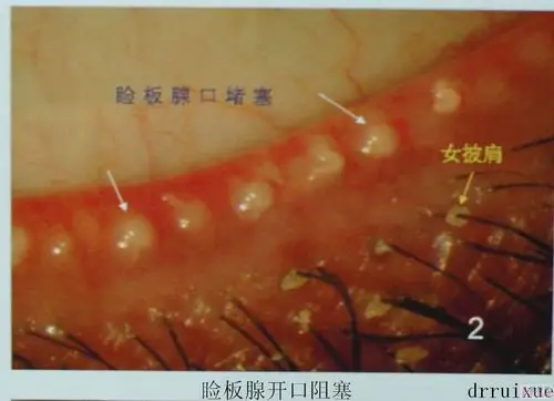 睑板腺口阻塞.jpg