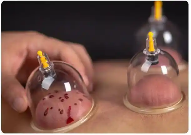 03拔罐后的注意事项:1,不要洗澡拔罐以后8小时之内千万不要洗澡,因为