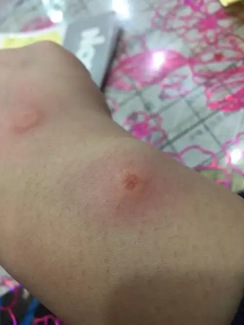 被虫子还是蚊子咬了.抹了点药.但是开始流脓水了.怎么办.