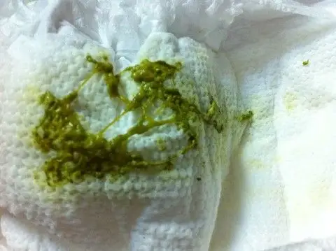 求助,有图慎入(宝宝大便)