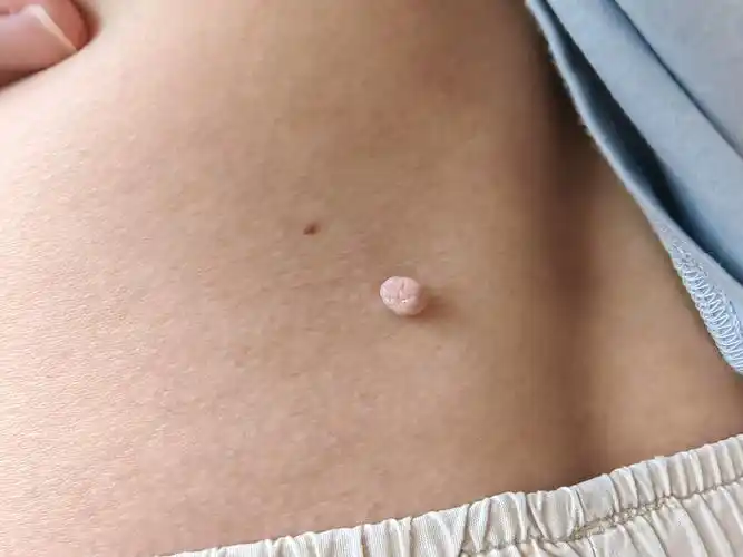 皮肤镜下更可以清晰看到软纤维瘤的特征.