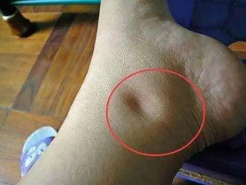 注意了脚上出现这3个信号说明癌细胞已经盯上你了