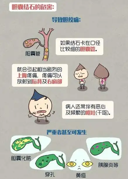 胆结石怎样才能把石头排出来(胆结石怎样才能把石头排出来图片)