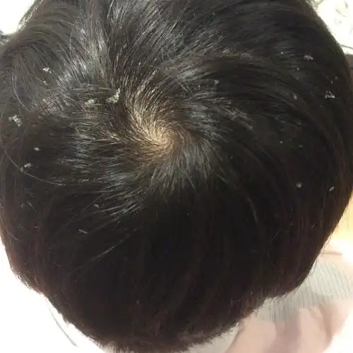 头皮屑很大块,用米醋洗的效果不持久怎么办?