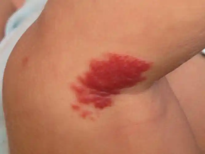 新生婴儿膝盖侧面上有块红记,这是什么,需不需要治疗?