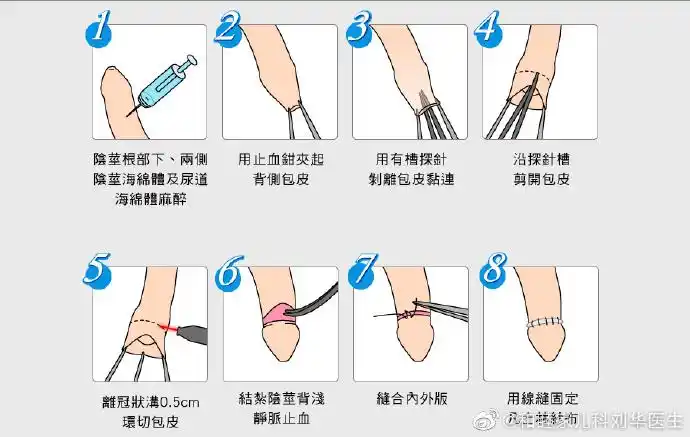 答: 我国男性3岁之前几乎都存在包皮过长或包茎,在对4～18岁男性的
