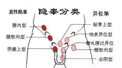 2:隐睾易忽视,家长一定要摸一摸另外,由于隐睾没有疼痛不适,很容易被