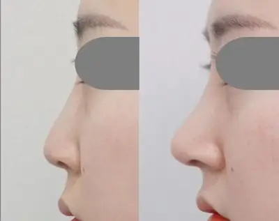 假体隆鼻前后对比图