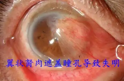 2翼状胬肉遮盖瞳孔导致失明.jpg